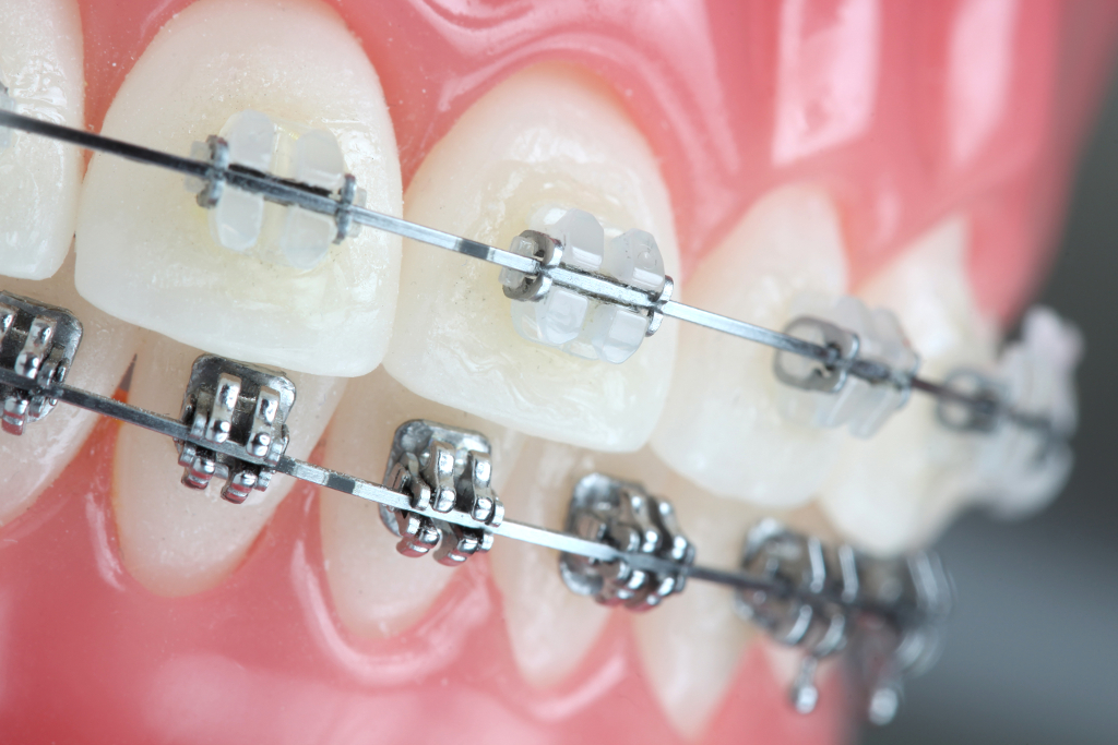 Fixed Lingual with ceramics braces